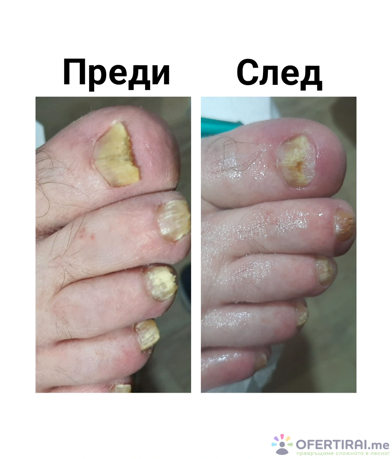 Терапевтичен педикюр и маникюр 