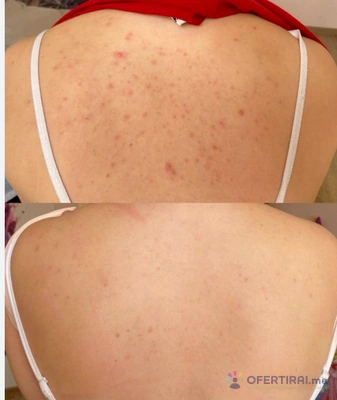 Почистване +терапия за гръб - Image 2