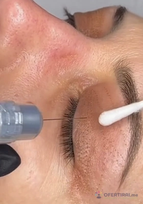 Плазма пен неоперативна блеферопластика Плазма пен неоперативна блеферопластика - Image 2