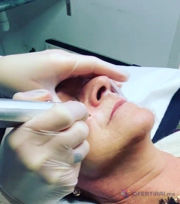 Плазма пен неоперативна блеферопластика Плазма пен неоперативна блеферопластика - Image 3