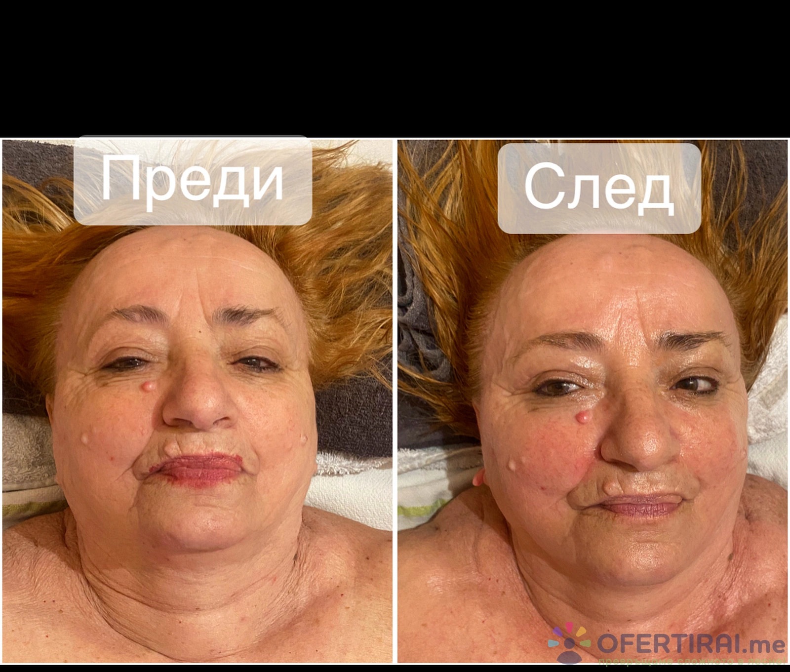 Остеоестика за лице, шия и деколте
